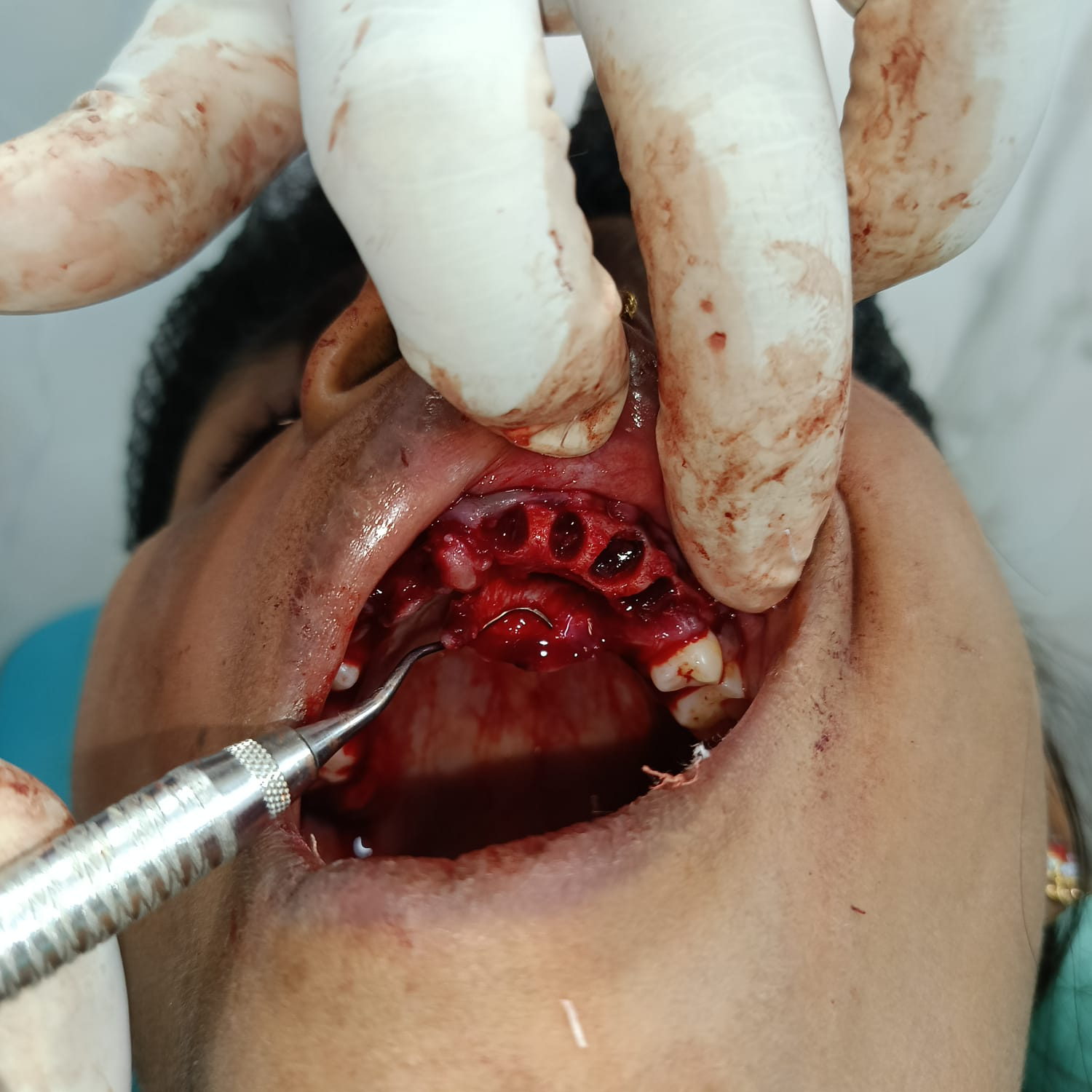 Drilling holes for immediate dental implant placement in upper jaw